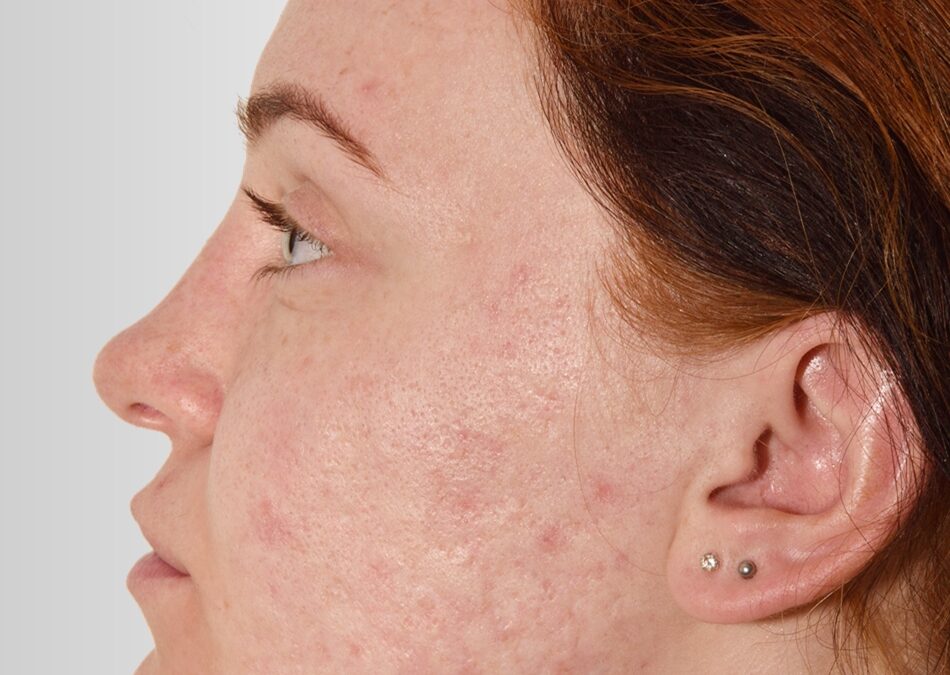Treating Acne From the Root Cause