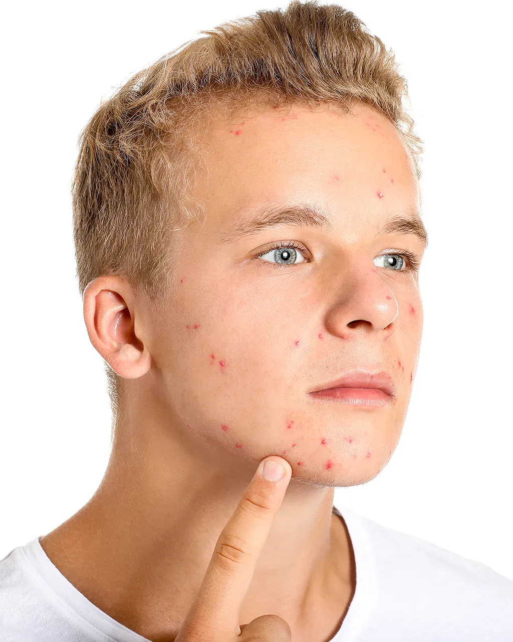 DMK Acne Treatment 01